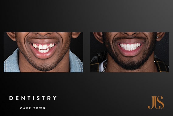 Adult Orthodontics | Dr JJ Serfontein