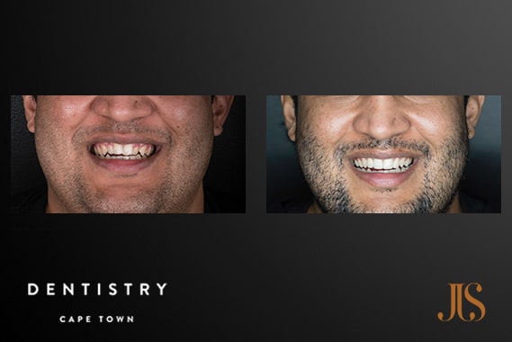 Dr JJ Serfontein | Adult Orthodontics
