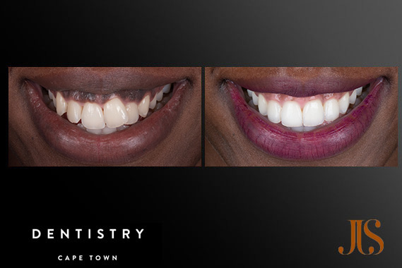Orthodontist in Cape Town | Dr JJ Serfontein