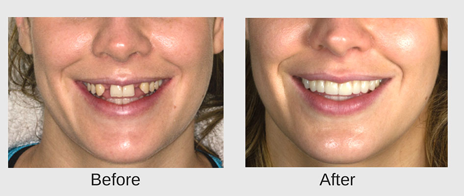 Before and after hollywood smile dentist cape town