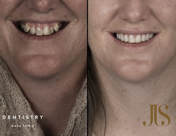 How do I maintain my clear aligner results? | Dr JJ Serfontein