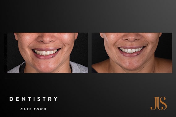 Orthodontics Cape Town | Dr JJ Serfontein