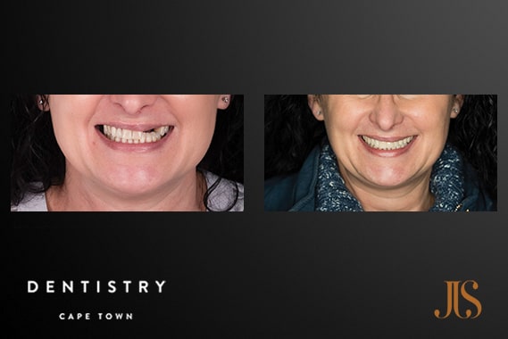 Dental Implant Reconstruction | JJS Dentistry