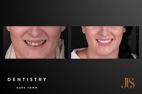 Dr JJ Serfontein | Dental Implantreconstruction