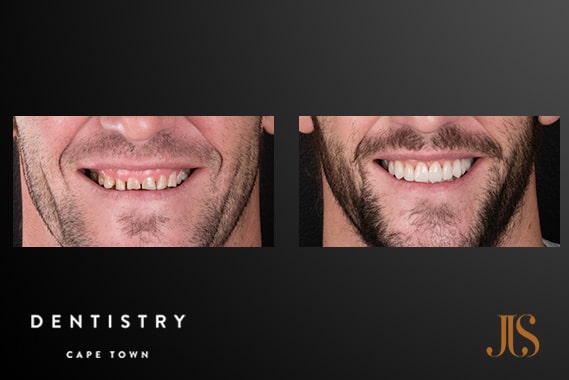 Dr JJ Serfontein | Smile Makeover - Resin