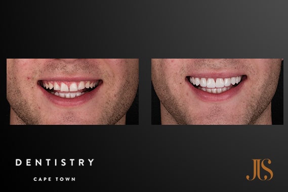 Smile Makeover - Resin | Dr JJ Serfontein