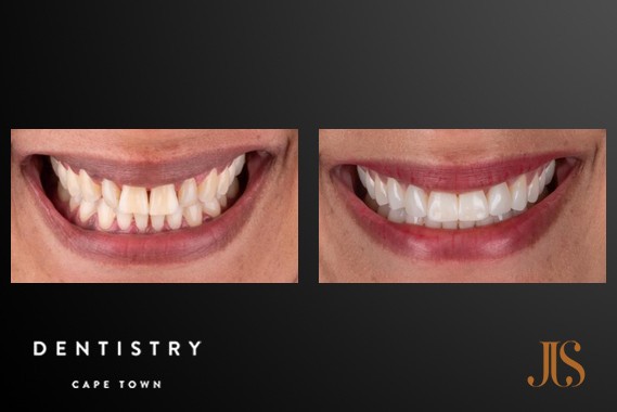 Smile Makeover Cape Town