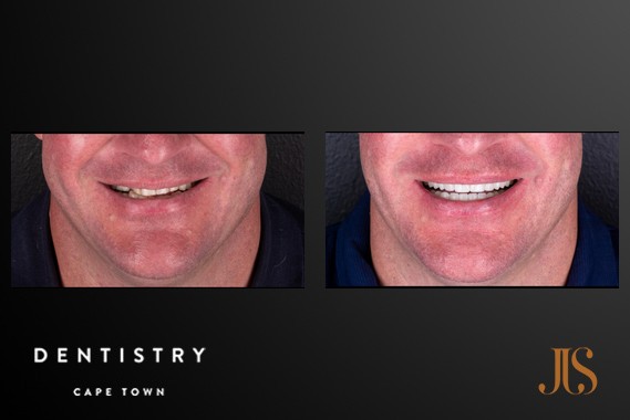 Smile Makeover Cape Town