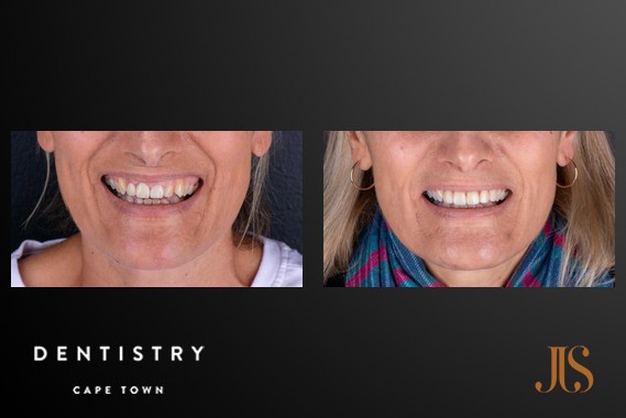 Smile Makeover Cape Town