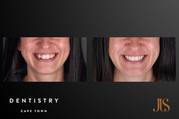 Smile Makeover Cape Town