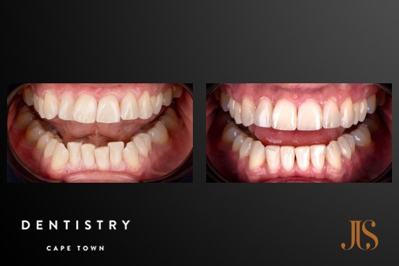 Smile Makeover Cape Town