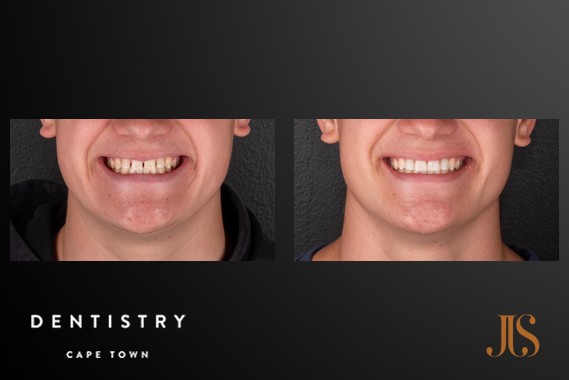 Smile Makeover Cape Town