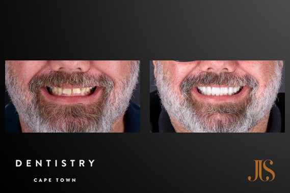 Smile Makeover Cape Town