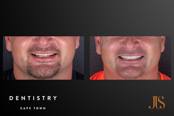 Smile Makeover Cape Town