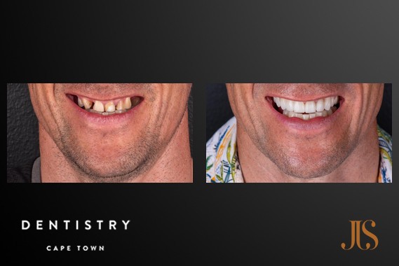 Smile Makeover Cape Town