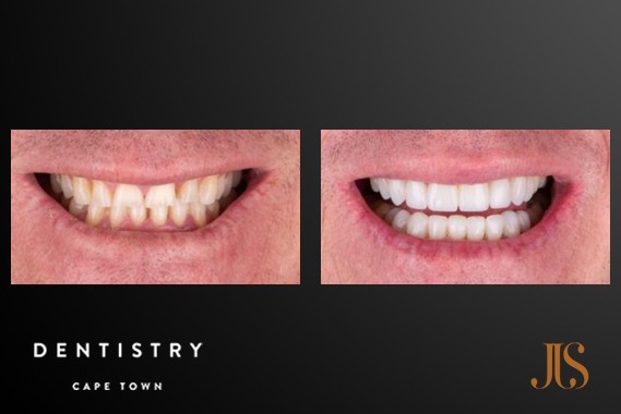 Smile Makeover Cape Town