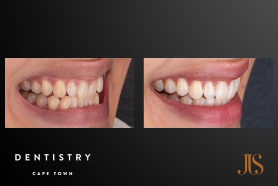 Smile Makeover Cape Town