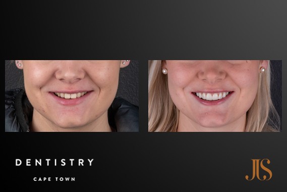 Teeth Whitening Cape Town