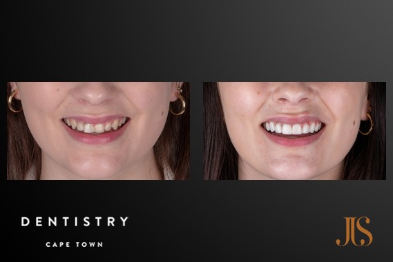 Teeth Whitening Cape Town