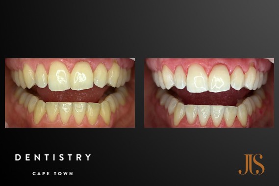 Teeth Whitening Cape Town