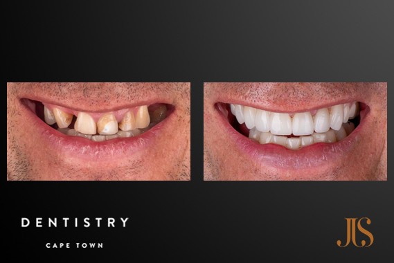 Teeth Whitening Cape Town
