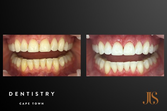 Teeth Whitening Cape Town