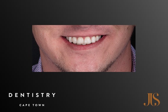 Cosmetic Dentistry Cape Town