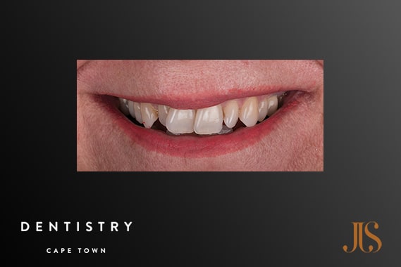 Cosmetic Dentistry Cape Town