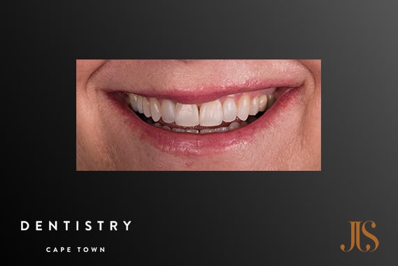 Cosmetic Dentistry Cape Town