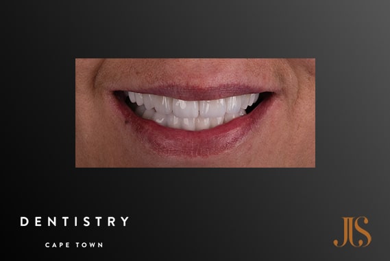 Cosmetic Dentistry Cape Town