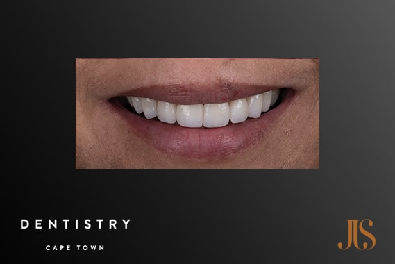 Cosmetic Dentistry Cape Town