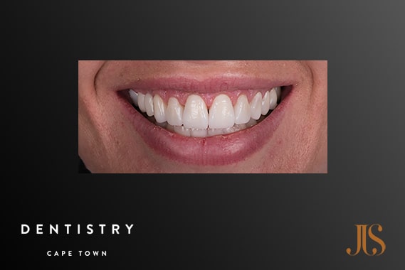 Cosmetic Dentistry Cape Town