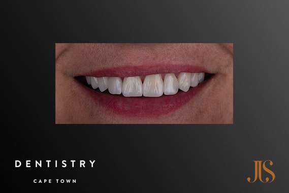 Cosmetic Dentistry Cape Town