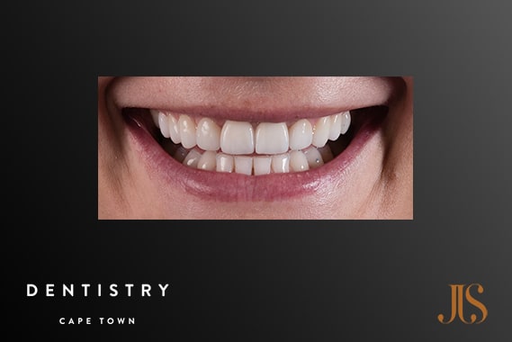 Cosmetic Dentistry Cape Town