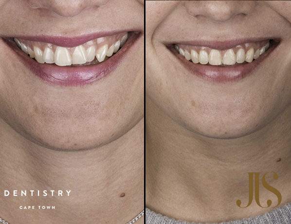 How does orthodontics work? | JJS Dentistry