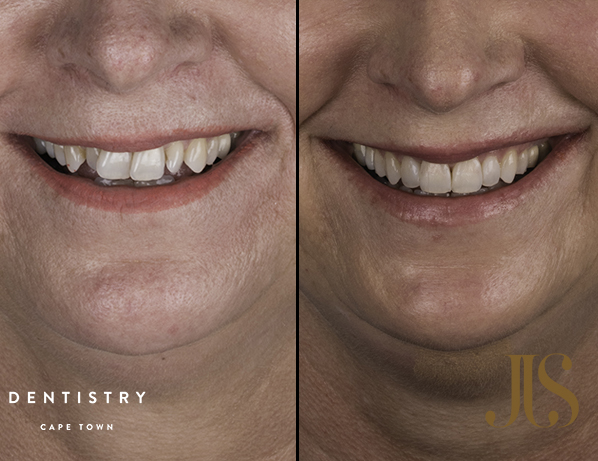 Orthodontics Cape Town | JJS Dentistry