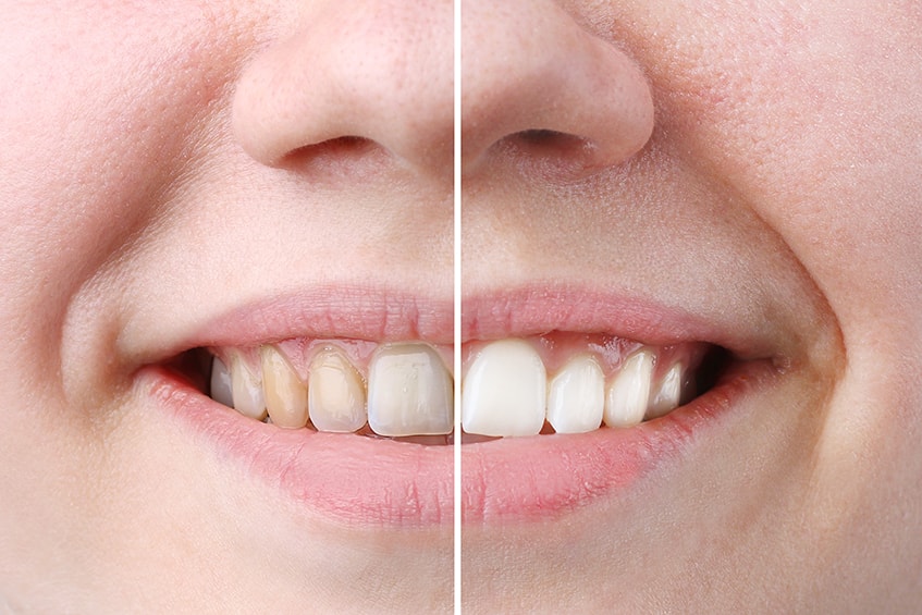 teeth whitening cape town | JJS Dentistry
