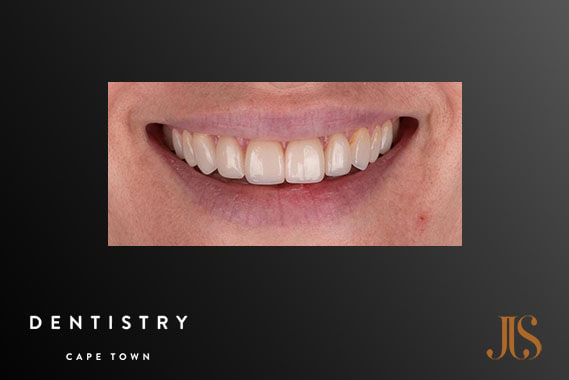 Cosmetic Dentistry Stellenbosch