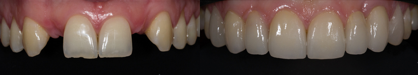 Smile Makeover Cape Town | Dentist Cape Town