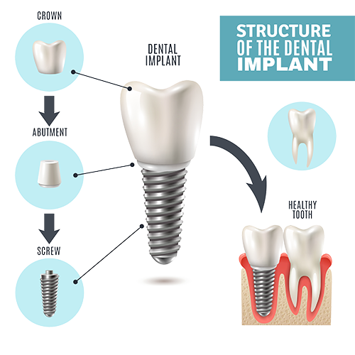 How do dental implants work?