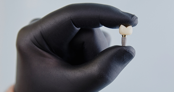 Dental Implants Reconstruction