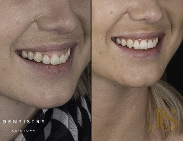 What are the benefits of Invisalign? | JJS Dentistry