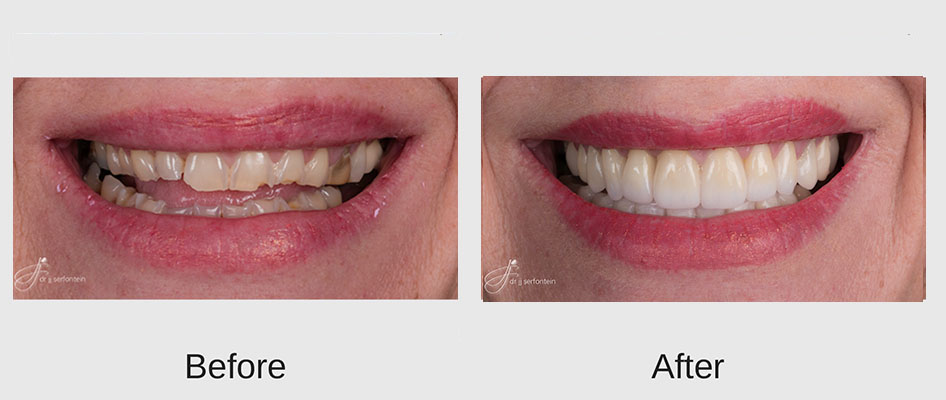 Rehabilitative Dentistry Cape Town | JJS Dentistry