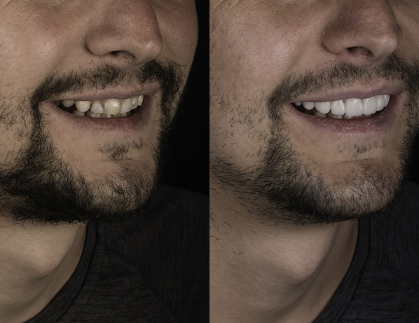 JJS Dentistry | Smile Makeover