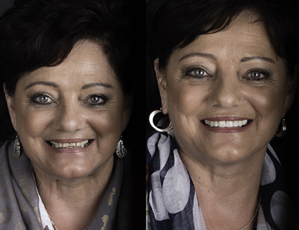 Smile Makeover Cape Town | JJS Dentistry