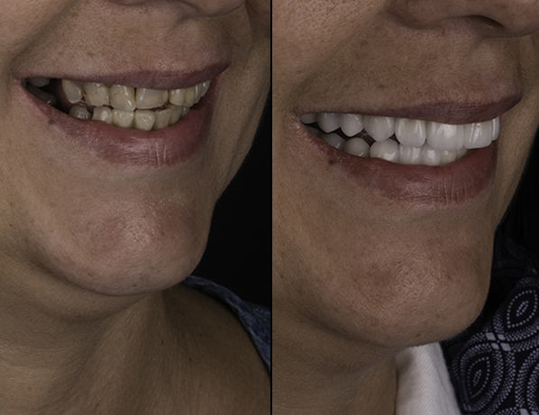 what is the recovery time for dental implants?