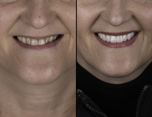 Who qualifies for smile makeovers? | JJS Dentistry