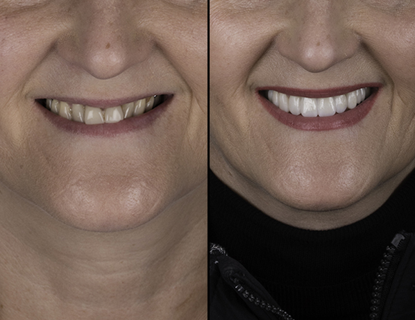 How long do dental implants last?